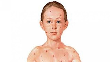 Su Çiçeği Bitkisel Çözüm