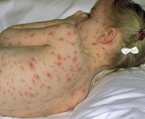 Su Çiçeği Virüsü Belirtileri ve Tedavisi