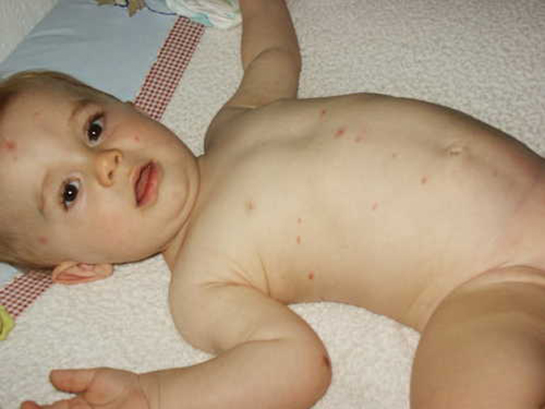 Su Çiçeği Döküntüleri Belirtileri ve Tedavisi