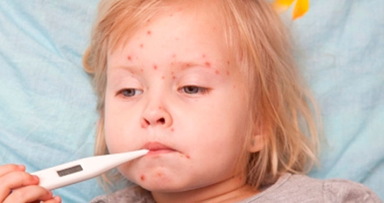 Su Çiçeği Hastalığı Belirtileri ve Tedavisi