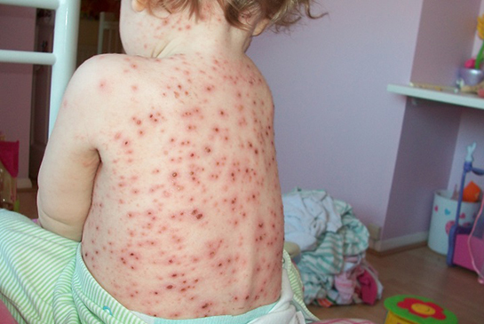 Su Çiçeği Yaraları Belirtileri ve Tedavisi